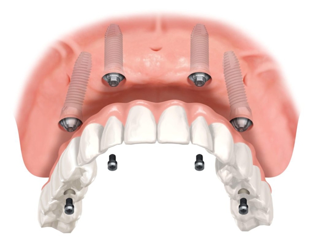impianti dentali all on four roma studio kol