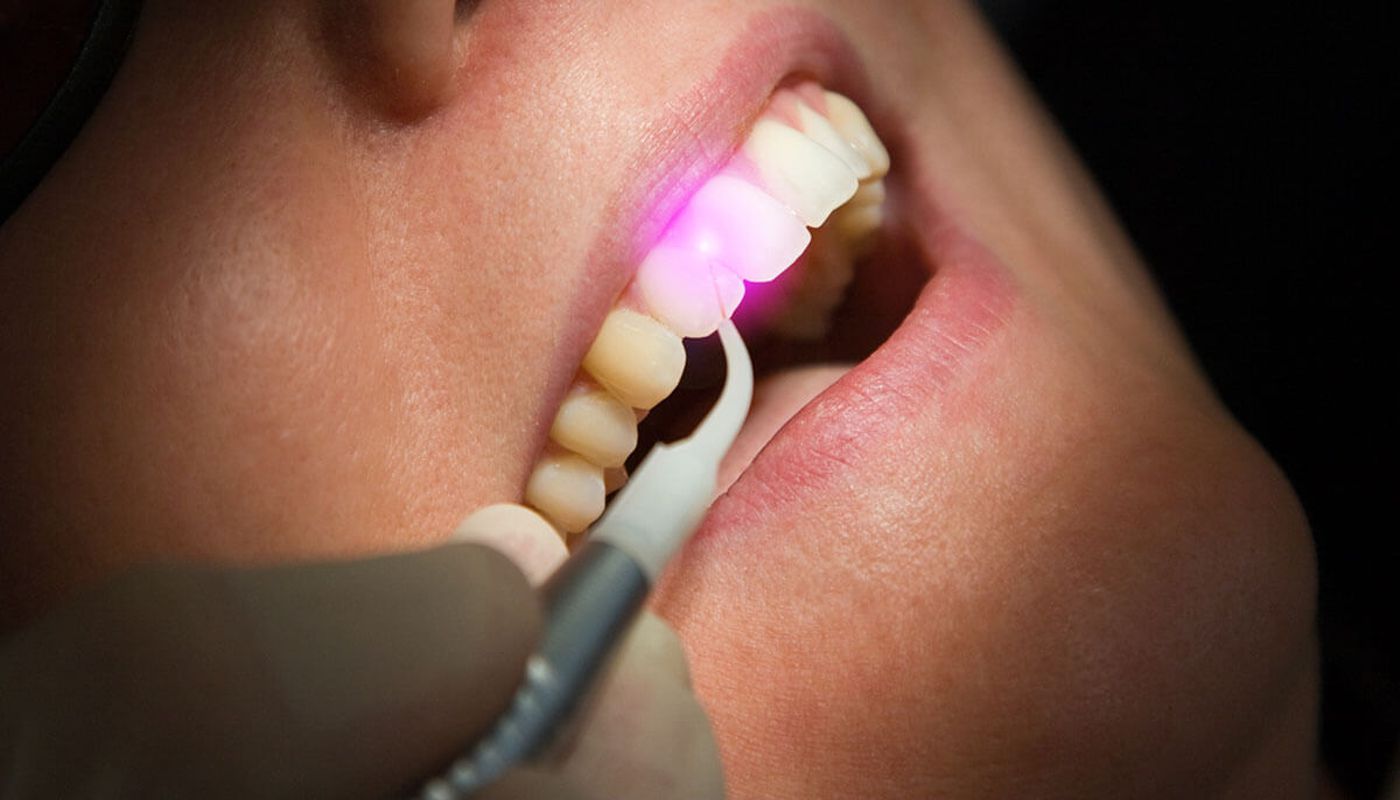 Laser terapia parodontite Studio Kol Roma