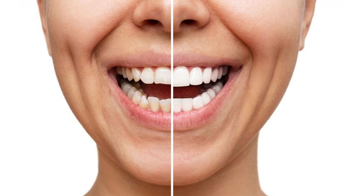 Faccette dentali Studio Kol Roma
