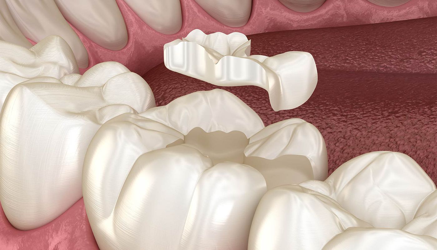 Intarsio dentale Studio Kol Roma