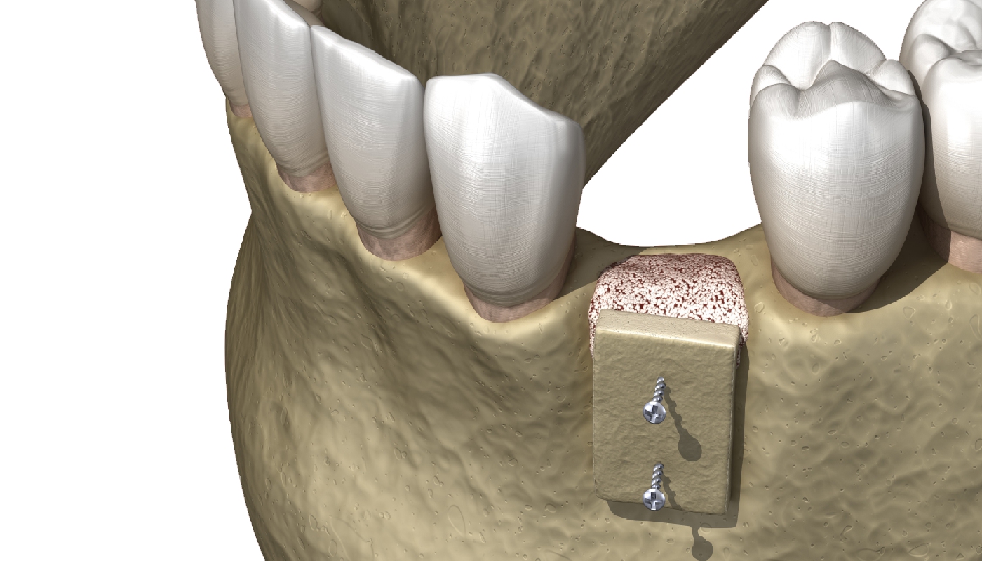 Trapianti dentali Studio Kol Roma