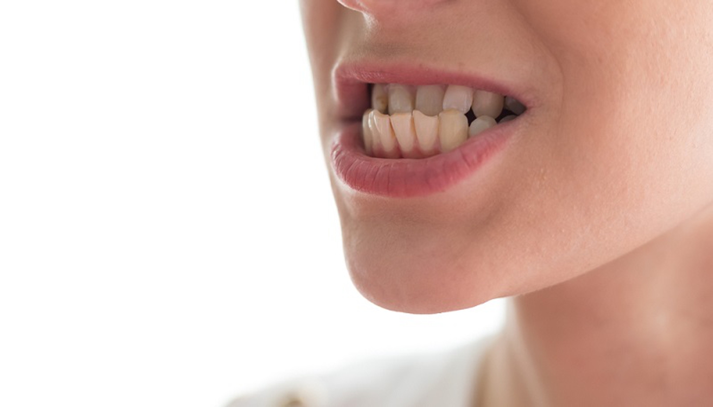Malocclusioni dentali Studio Kol Roma