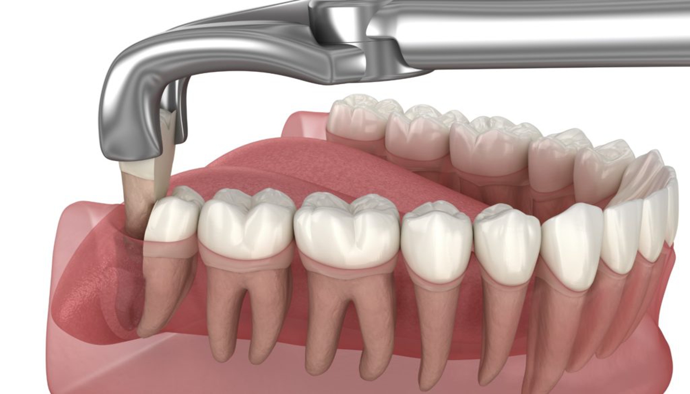 Estrazione denti del giudizio Studio Kol Roma