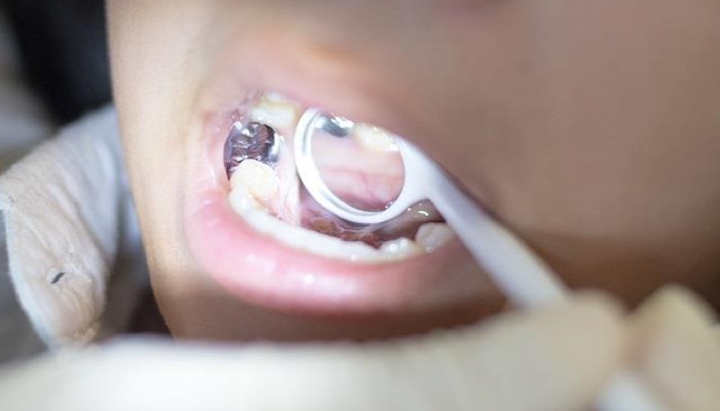Rimozione amalgame dentali Studio Kol Roma