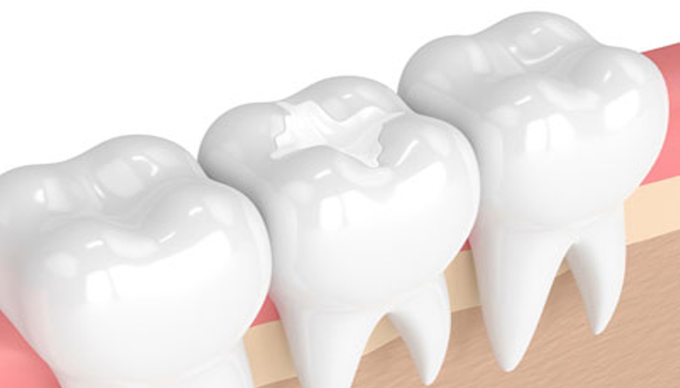 Sigillature dentali Studio Kol Roma